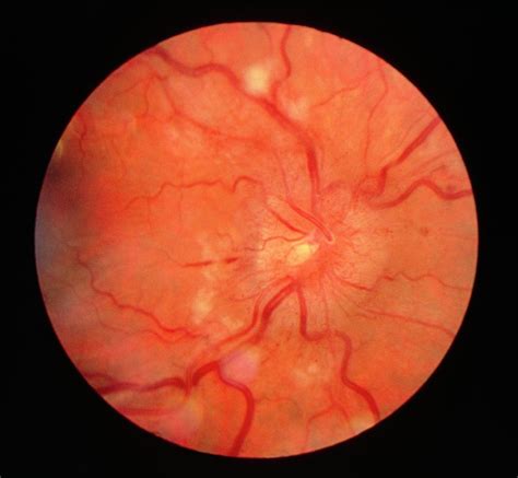Retinal Arteriyel Makroanevrizma-Mayıs 2012 Sorusu